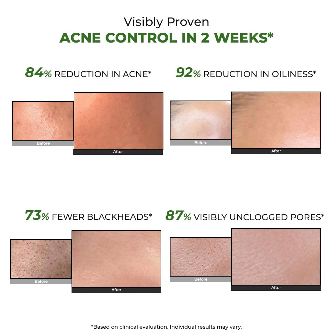 Before and after skin comparisons showing acne control benefits with text indicating reduction in acne, oiliness, blackheads, and unclogged pores.