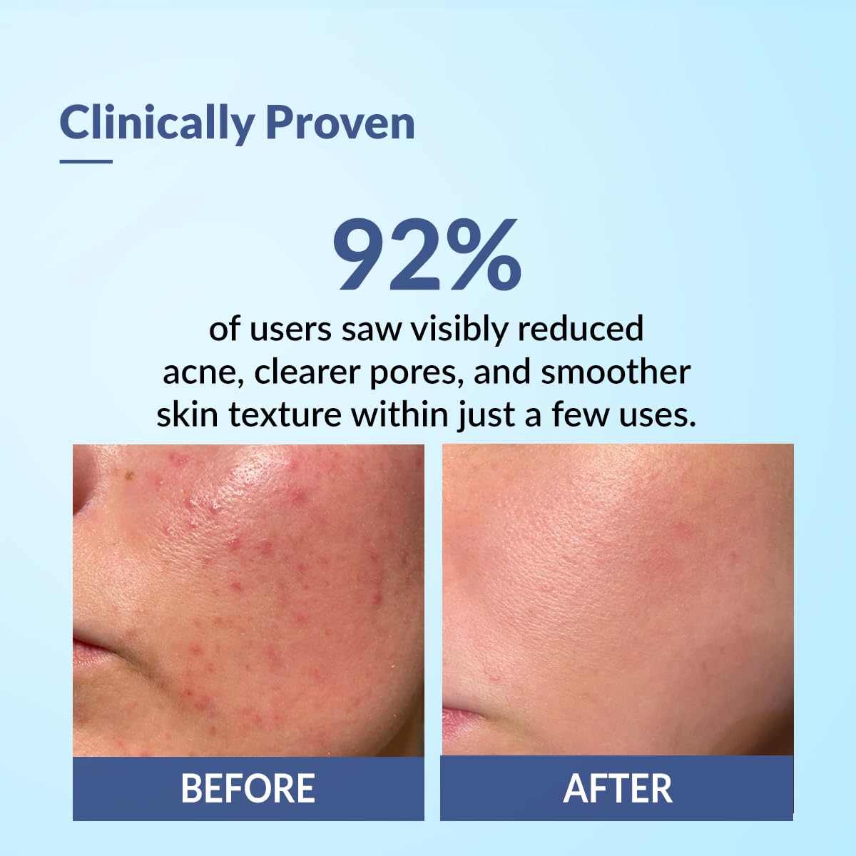 Fixderma Salyzap Face gel, Oil free hydrating gel, Deep Moisturization, Moisturizer for acne prone skin, Soothes acne and redness, non-comedogenic, non-greasy gel, Dermatologist tested - 50ml