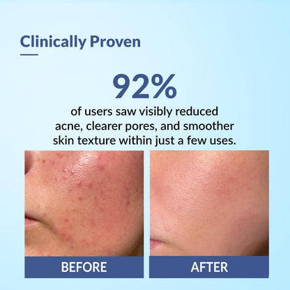 Fixderma Salyzap Face gel, Oil free hydrating gel, Deep Moisturization, Moisturizer for acne prone skin, Soothes acne and redness, non-comedogenic, non-greasy gel, Dermatologist tested - 50ml