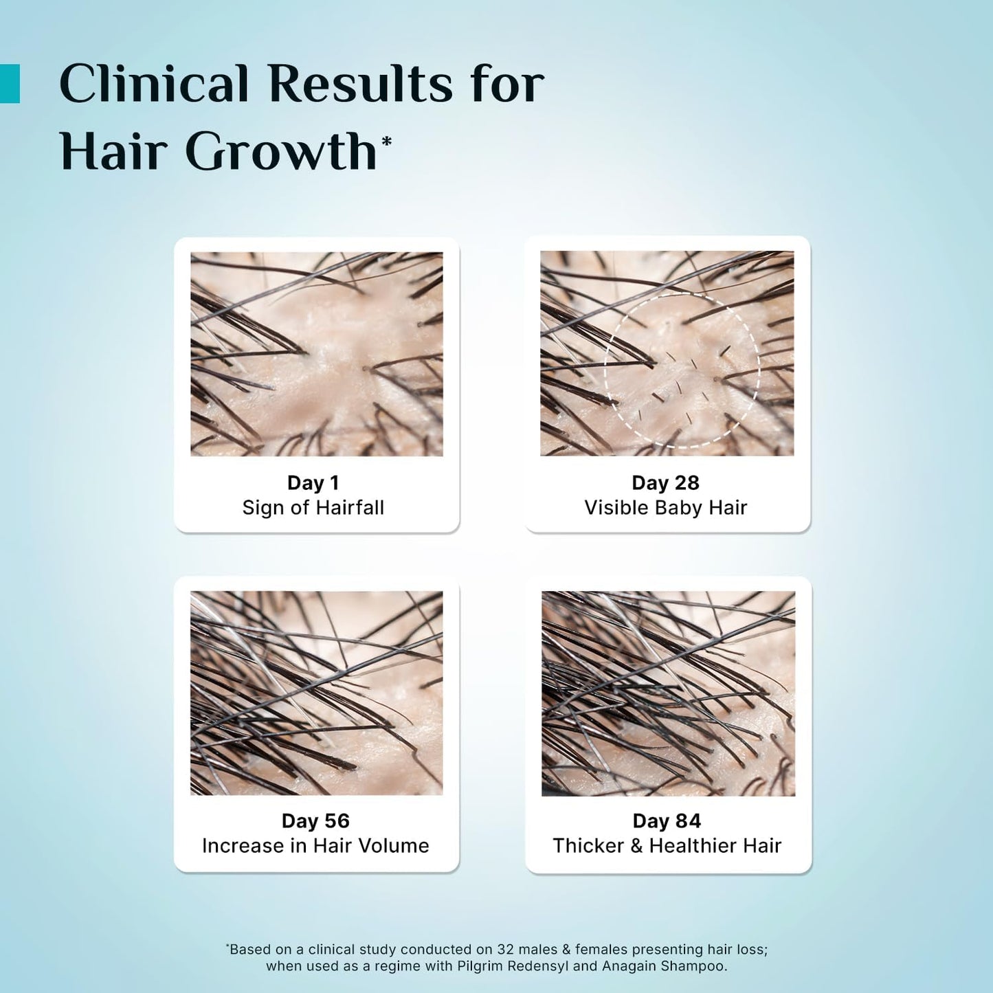 Pilgrim Redensyl 3% + Anagain 4% + 5% Capilia Stem Advanced Hair Growth Serum (30ml) for Scalp with Korean Black Rice & Rosemary | Control Hair Fall, Stimulate Hair Regrowth, Increase Hair Density