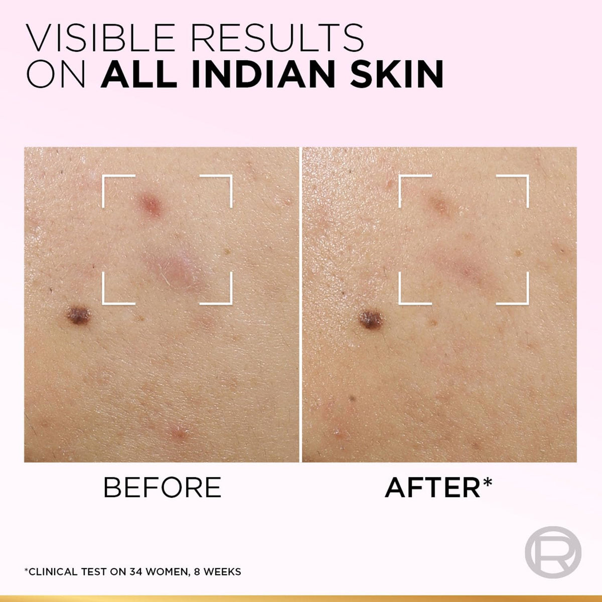 Before and after comparison of skin treatment on Indian skin