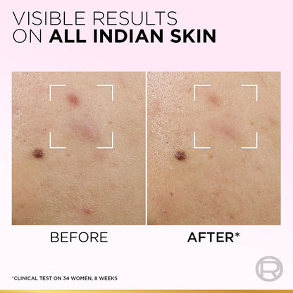 Before and after comparison of skin treatment on Indian skin