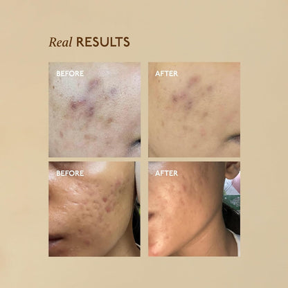 Before and after skin treatment results on a beige background