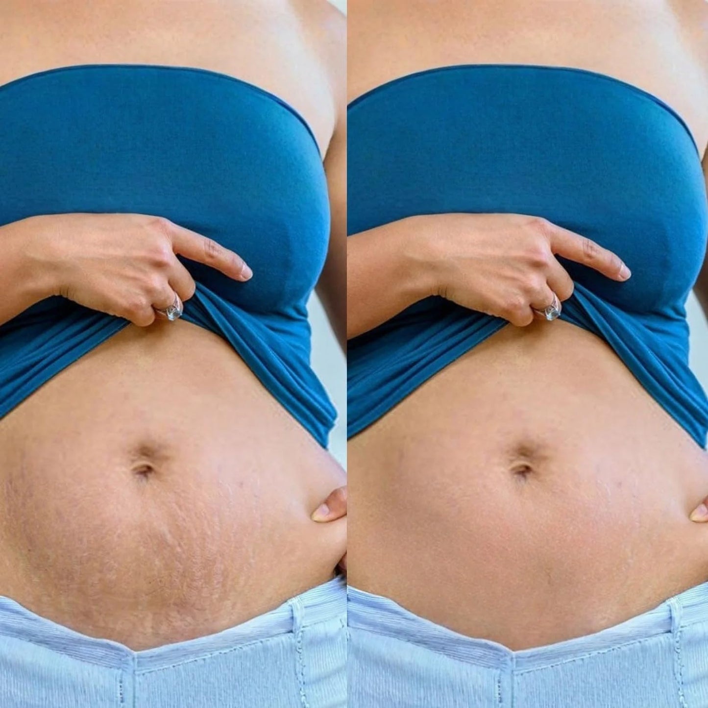 Pokonut Stretch Marks Cream for Women & Men | For Pregnancy, After Delivery & Weight Loss | Fades Old & New Marks on Belly, Thighs & Hips | Hyaluronic Acid + Rosehip Oil | Non-Sticky | 50g