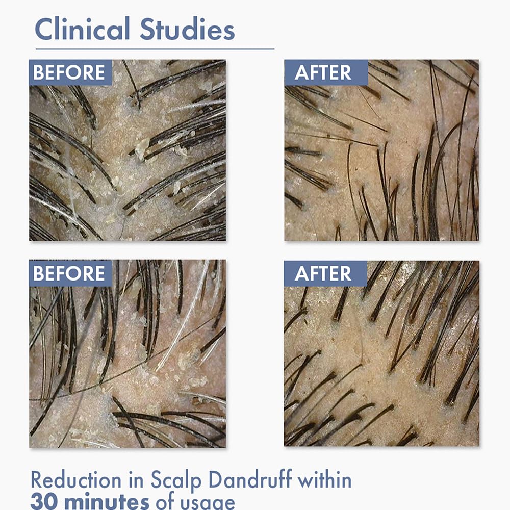 Before and after clinical study results for scalp dandruff reduction with text indicating time of usage.