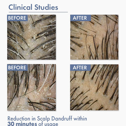 Before and after clinical study results for scalp dandruff reduction with text indicating time of usage.