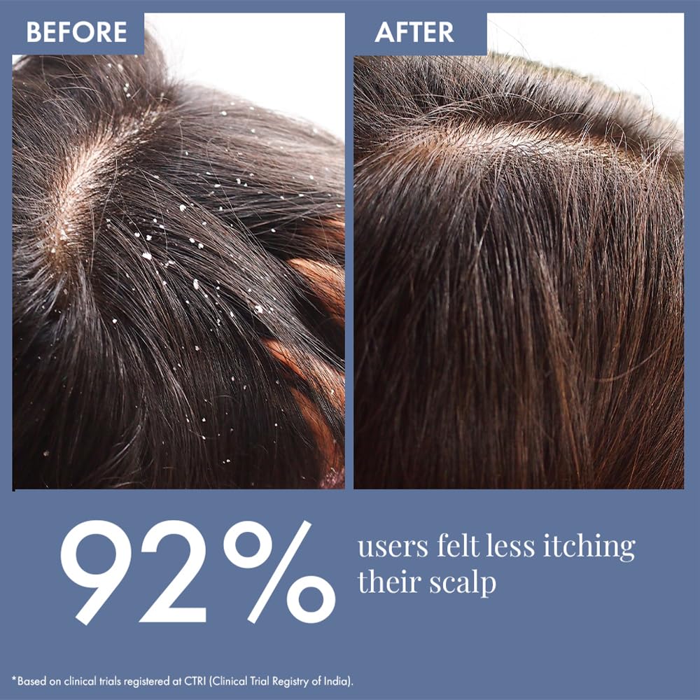 Before and after comparison of scalp with dandruff, showing 92% improvement.