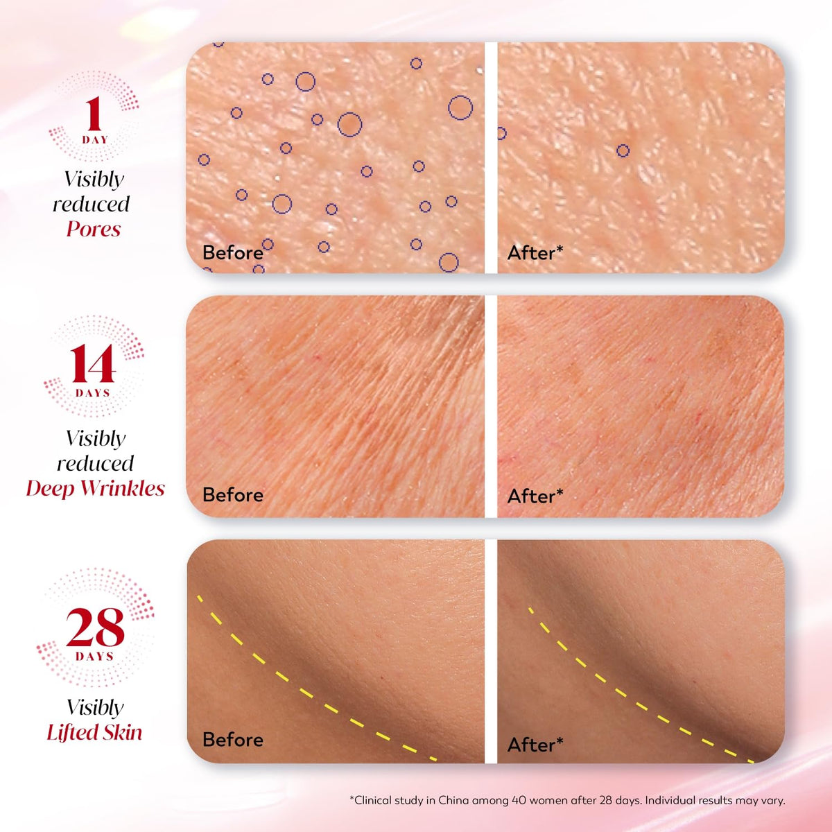 Before and after skin treatment results showing visibly reduced pores, deep wrinkles, and lifted skin.