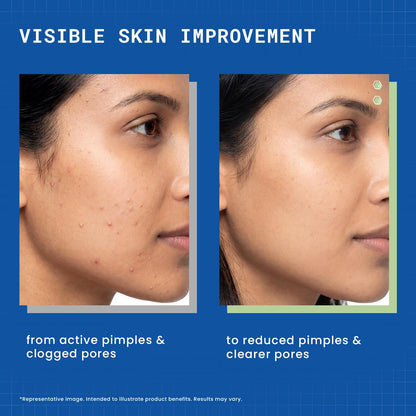 DERMDOC 2% Salicylic Acid w/w Pimple Gel, 5ml | Acne Spot Treatment for Oily & Acne-Prone Skin | Reduces Pimples, Redness & Inflammation | Clears Clogged Pores | Lightweight & Fast Absorbing | Anti-Acne Gel for Breakouts & Active Pimples