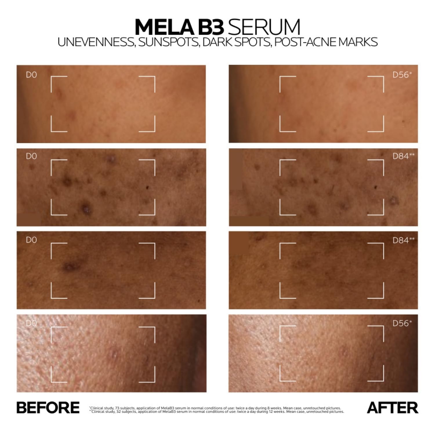 Before and after effects of Mela B3 Serum on skin with unevenness, sunspots, dark spots, and post-acne marks.