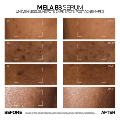 Before and after effects of Mela B3 Serum on skin with unevenness, sunspots, dark spots, and post-acne marks.