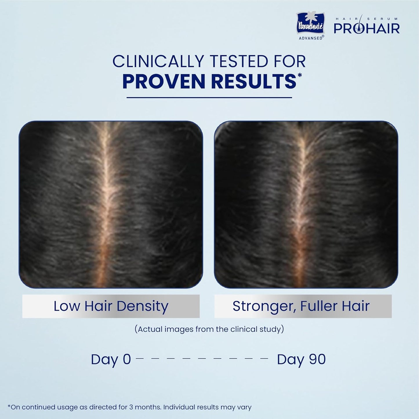 Before and after comparison of hair density with ProHair product, showing clinical results.