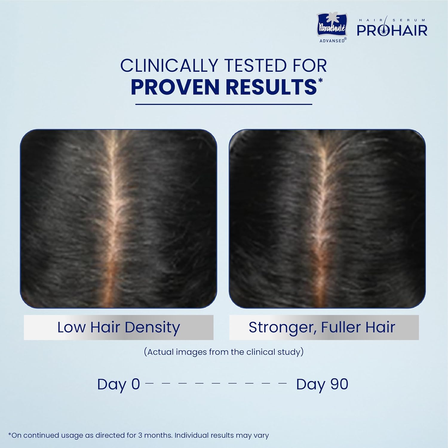Before and after comparison of hair density with ProHair product, showing clinical results.