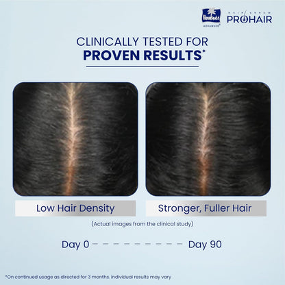 Before and after comparison of hair density with ProHair product, showing clinical results.