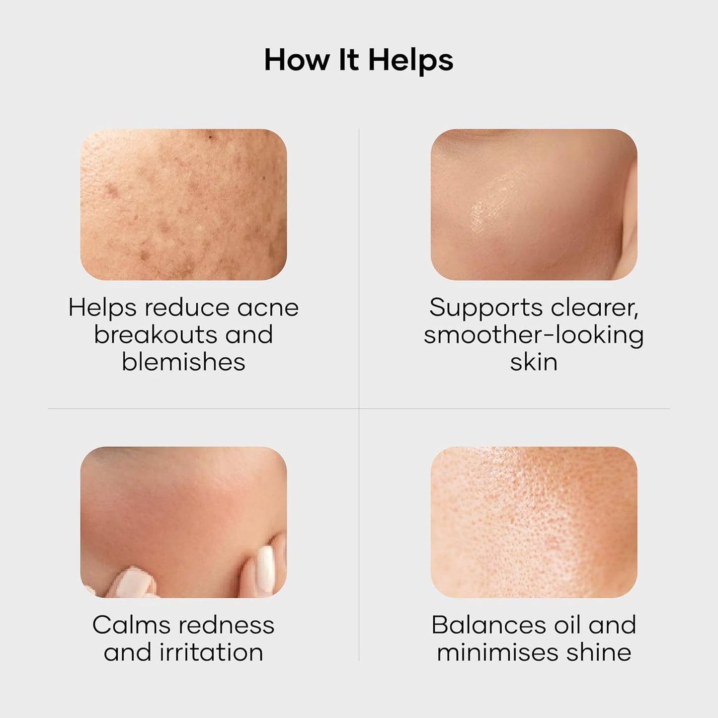 Cureskin Acne Control Gel | Acne Gel Helps Clear Blemishes Without Over Drying | Topical Pimple Cream Visibly Reduces Acne in One Day, 10 g (Pack of 1)