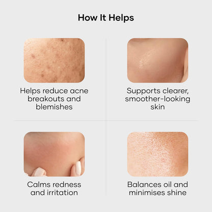 Cureskin Acne Control Gel | Acne Gel Helps Clear Blemishes Without Over Drying | Topical Pimple Cream Visibly Reduces Acne in One Day, 10 g (Pack of 1)