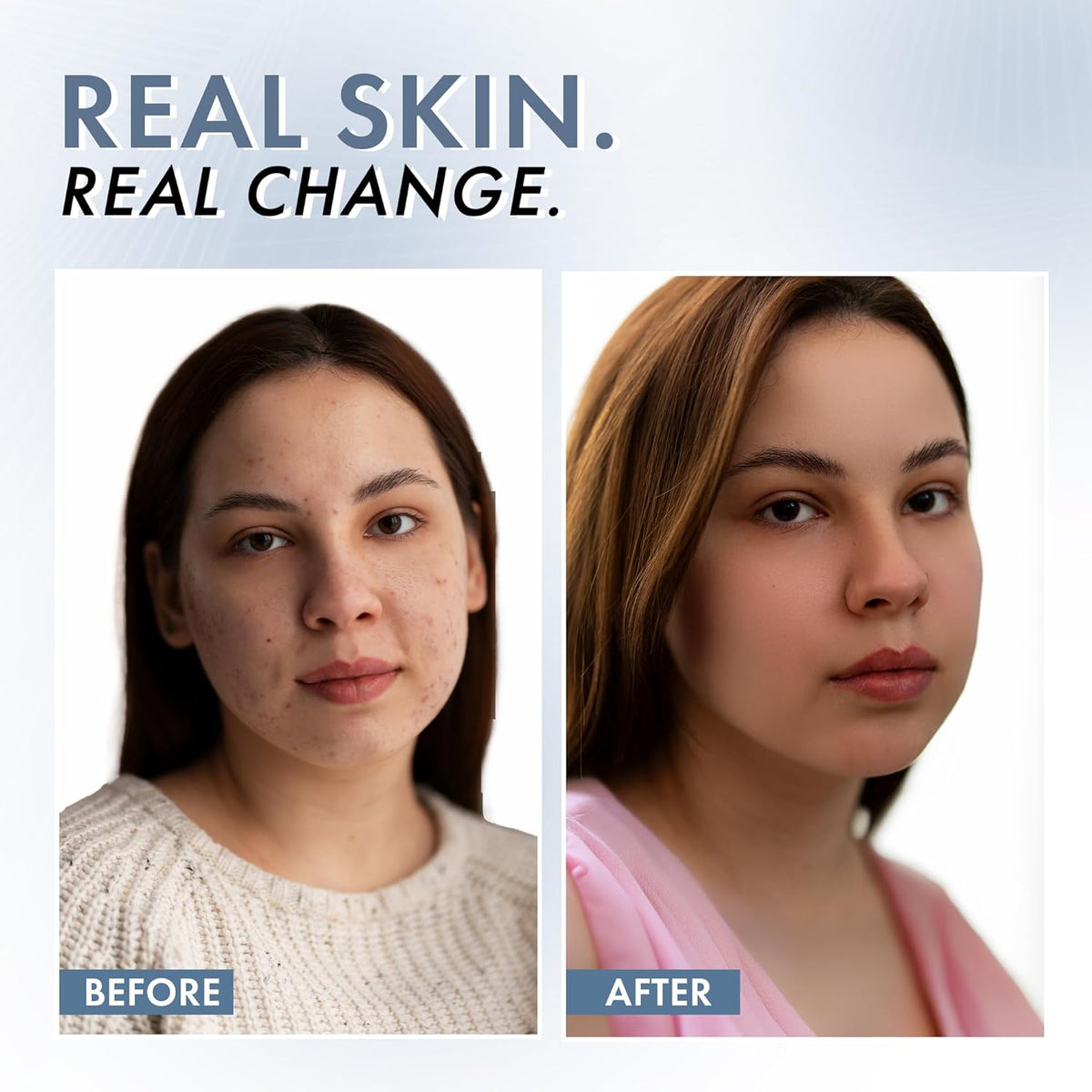 Before and after comparison of a woman's face with text 'Real Skin. Real Change.'