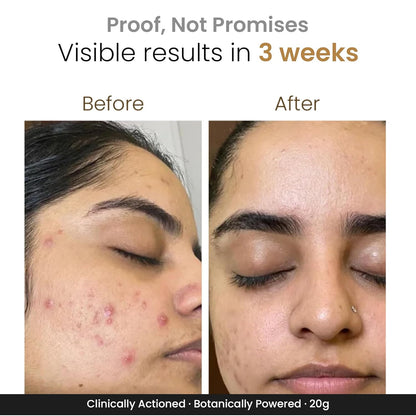 Personal Touch Zitsit Acne Spot Corrector Gel | 2% Salicylic Acid, Niacinamide & Zinc | Spot Corrector for Acne Marks, Dark Spots & Scars | Oil Control for Acne-Prone Skin | 20g