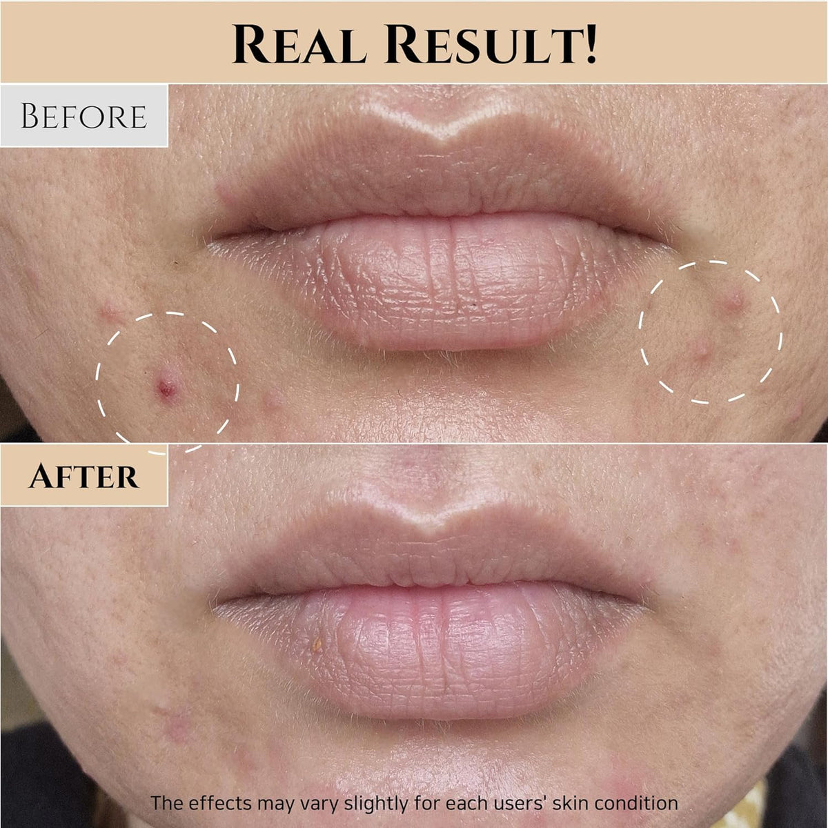 Before and after comparison of lips with text indicating 'Real Result!' and 'Before' and 'After' labels.