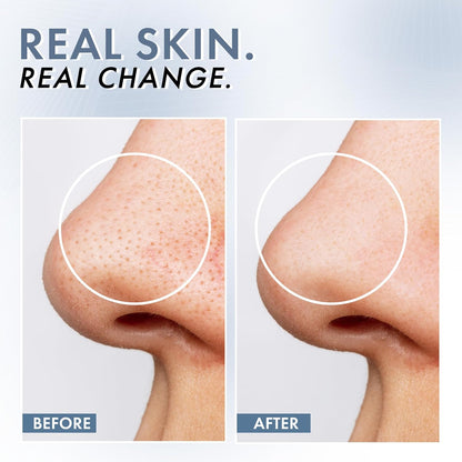 Before and after comparison of skin on a nose with 'Real Skin. Real Change.' text.