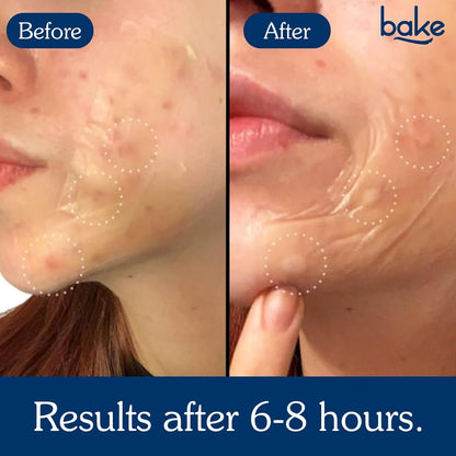 BAKE 2% Salicylic Acid Hydrocolloid Acne Absorbing (4 Patches) Surface Patch XL Pimple Patches for Blackheads Removal | Large Acne Erase Strips | Pore Cleansing & Reduces Whiteheads (10 Strips)