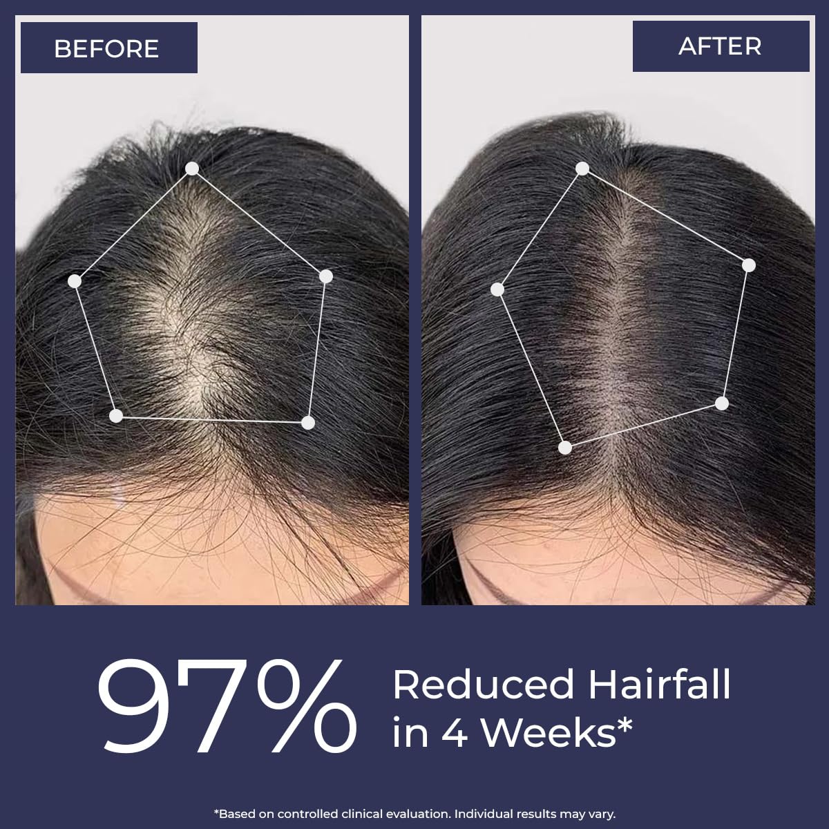 Before and after comparison of hairfall reduction with 87% decrease in 4 weeks, shown on a person's scalp.