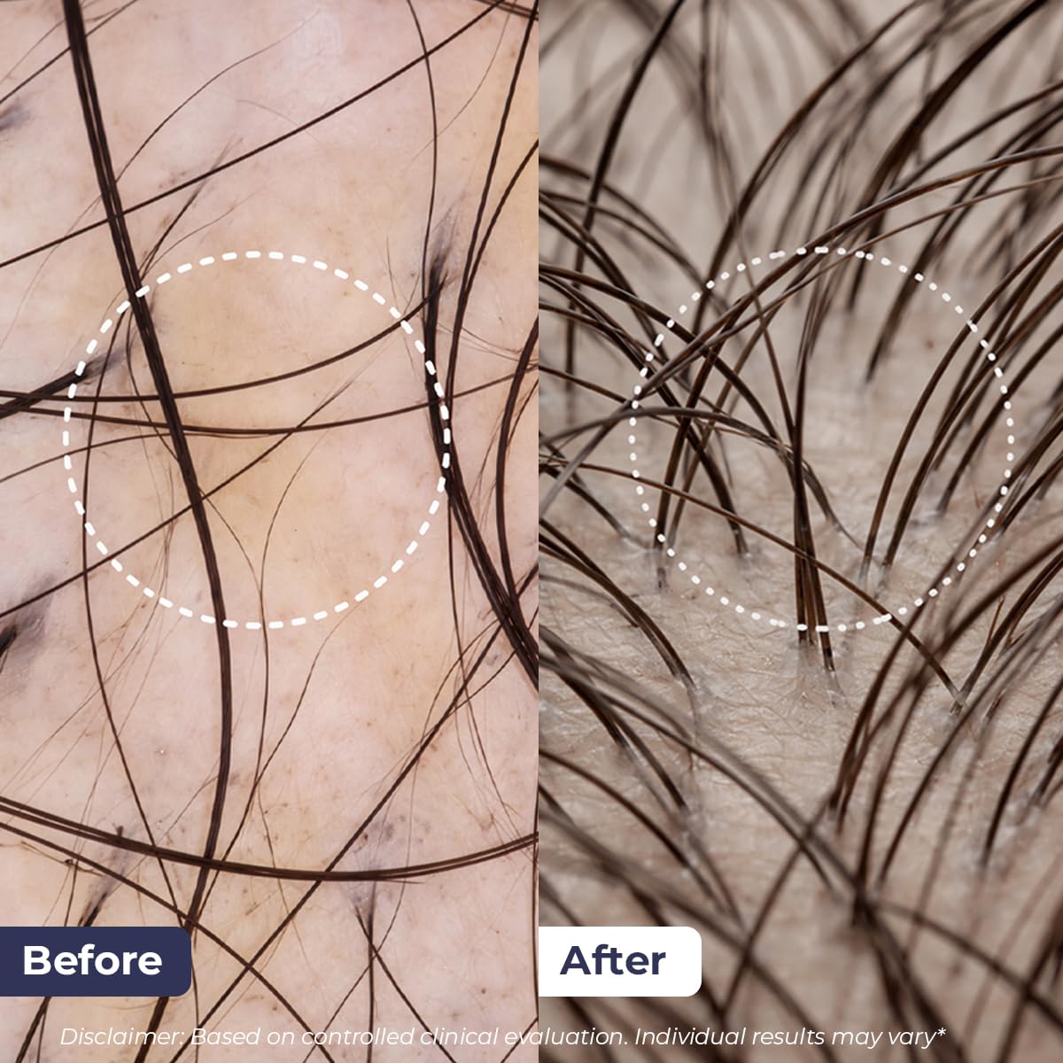 Before and after comparison of hair growth on skin