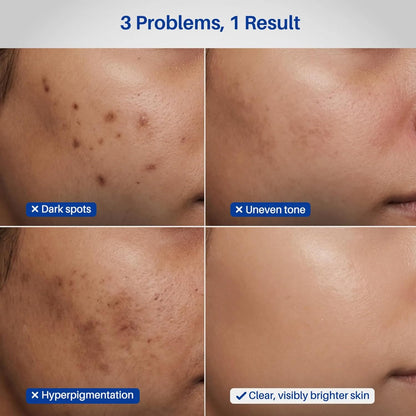DERMDOC 2% Kojic Acid Face Serum, 20ml | Dark Spots & Pigmentation Control | Brightening, Even-Tone Formula with Niacinamide + Alpha Arbutin + Glutathione | Spot Corrector Serum for Acne Marks, Tanning & Uneven Skin Tone