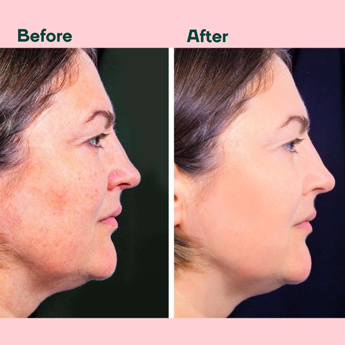 Before and after comparison of a woman's face on a pink background