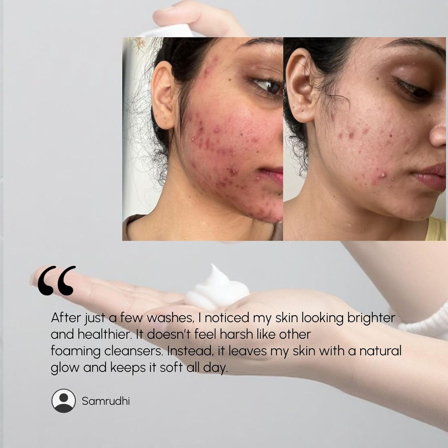 Brilliance Premium Hydrating Foaming Face Wash | Dermatologist Tested | Cocoyl Formula with 1% Salicylic Acid,Ceramide & Vitamin C, 100ml | Gentle Anti-Acne Cleanser for Acne-Prone Skin, Reduces Spots & Marks, Oil Control & Balanced Clear Skin