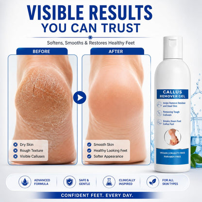 Callus Remover Gel for Feet, Softening and Exfoliating Formula, Dry Rough Skin Care, 200ml, for Men and Women