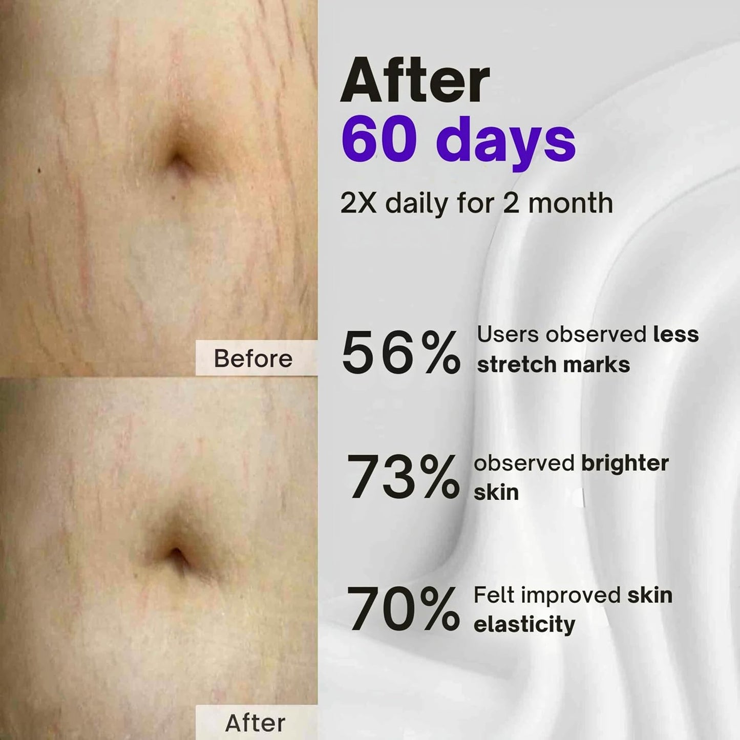Gynaecologist co-developed Anti Stretch Marks Cream suitable for all Stretch Marks | With Shea Butter, Hyaluronic Acid, and Collagen | Scar Removal | Uneven Skin Tone | Vitamin C and Retinol | 50ml