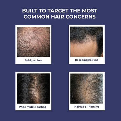 Advertisement for hair care product targeting common hair concerns with images of bald patches, receding hairline, wide middle parting, and hairfall & thinning.