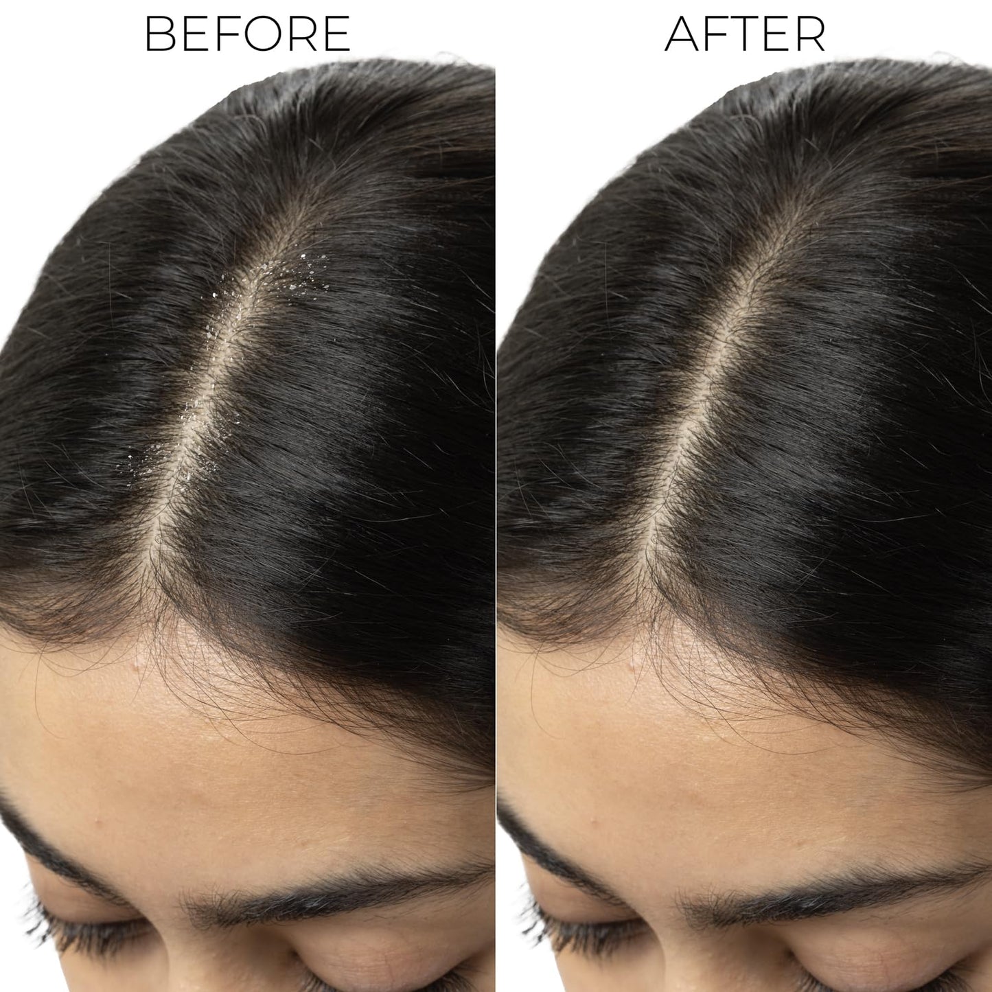 BRILLARE Professional Dandruff Control Shampoo | Anti Dandruff Shampoo for Women & Men | Shampoo for Dandruff & Itchy Scalp Relief | Reduces Flakes from 1st Wash | 300 ml