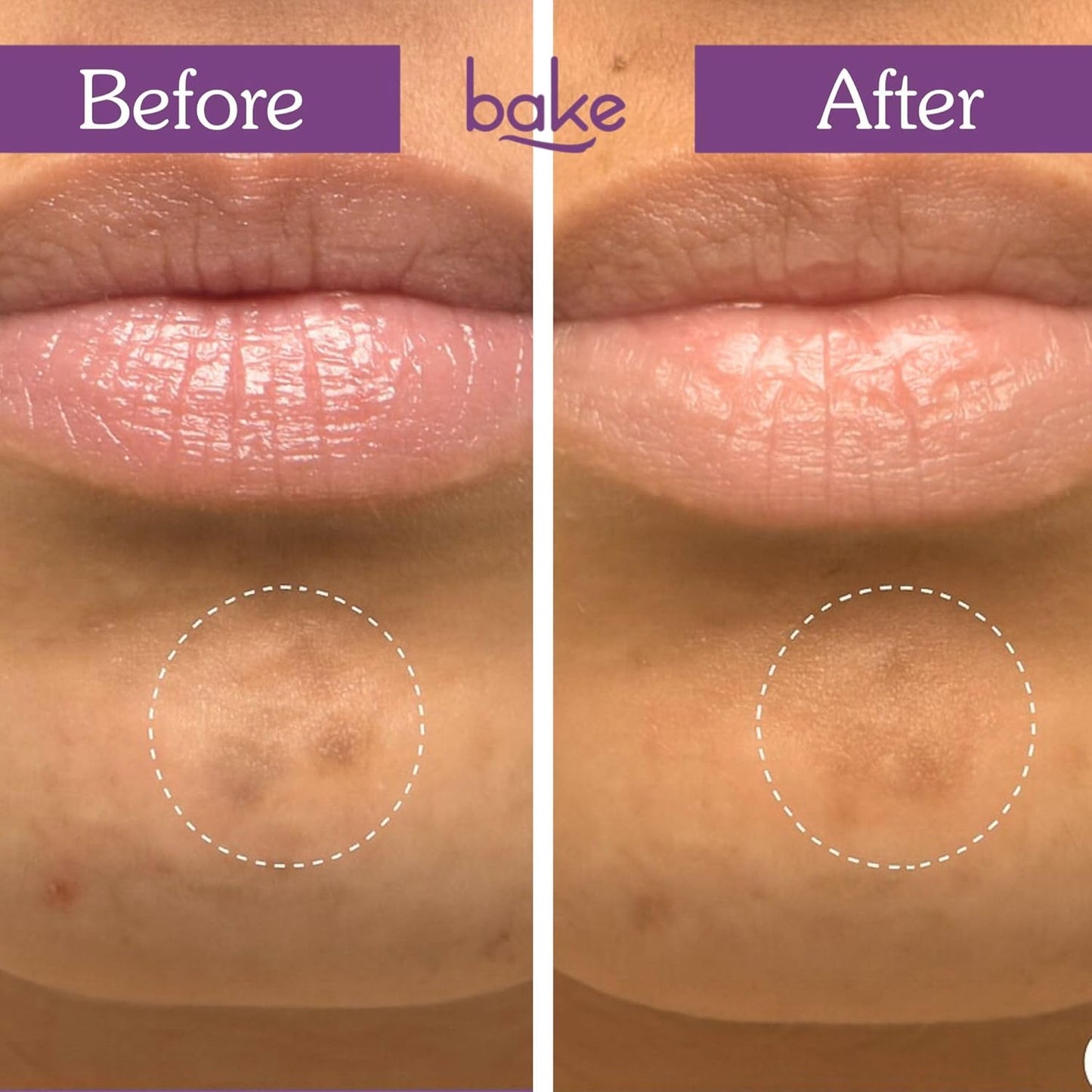 BAKE Micropoint Hydrocolloid Patches for Dark Spots with 2% Niacinamide, Salicylic Acid & Alpha Arbutin | For Acne Marks, Pigmentation, Dark Spots | 176 Melt-Tech Microneedles | Post Acne Breakouts & Dark Spots - 9 Patches