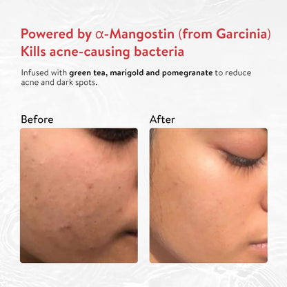 Ayouthveda Acne Enemy Face Wash Gel for Oily Skin | Acne & Pimple Control | Deep-Cleansing, Oil-Balancing & Pore-Purifying | Sulphate-Free Formula with Alpha-CURe Complex (α-Mangostin) & Garcinia | 100ml (Pack of 1)
