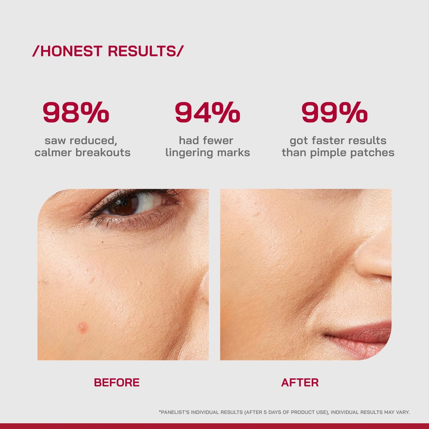 /PHD/ Salicylic Acid Acne Spot Treatment Gel 10g | Fast-Acting Pimple Remover & Acne Spot Corrector | Clear Gel with Peptazin™ Complex | Alternative to Pimple Patches | Salicylic Acid Gel for Face | Targets Breakouts & Reduces Spots Instantly