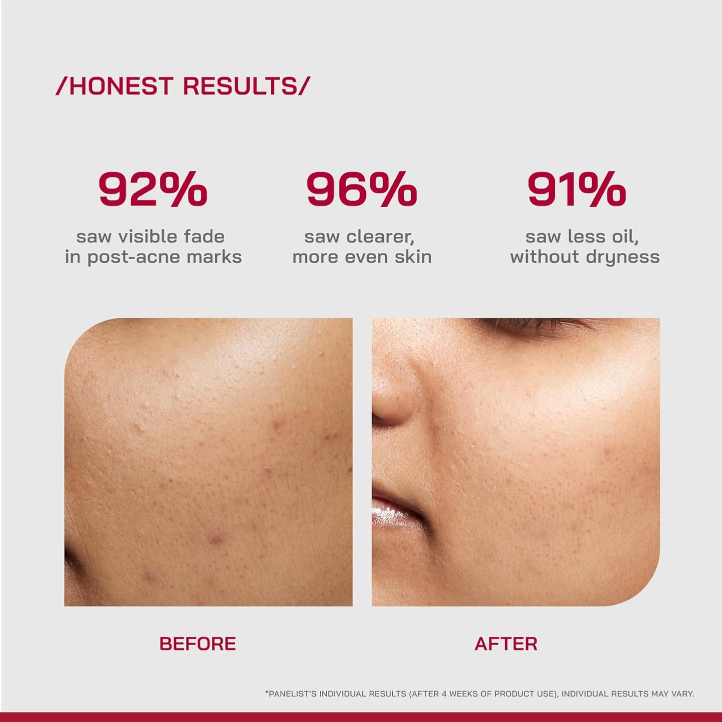/PHD/ 10% Niacinamide Spot Correcting Serum | Niacinamide for Oily Skin, Acne Scars & Enlarged Pores | Face Serum for Acne-Prone Skin with 2% NAG | Fades Marks, Controls Oil I 10ml
