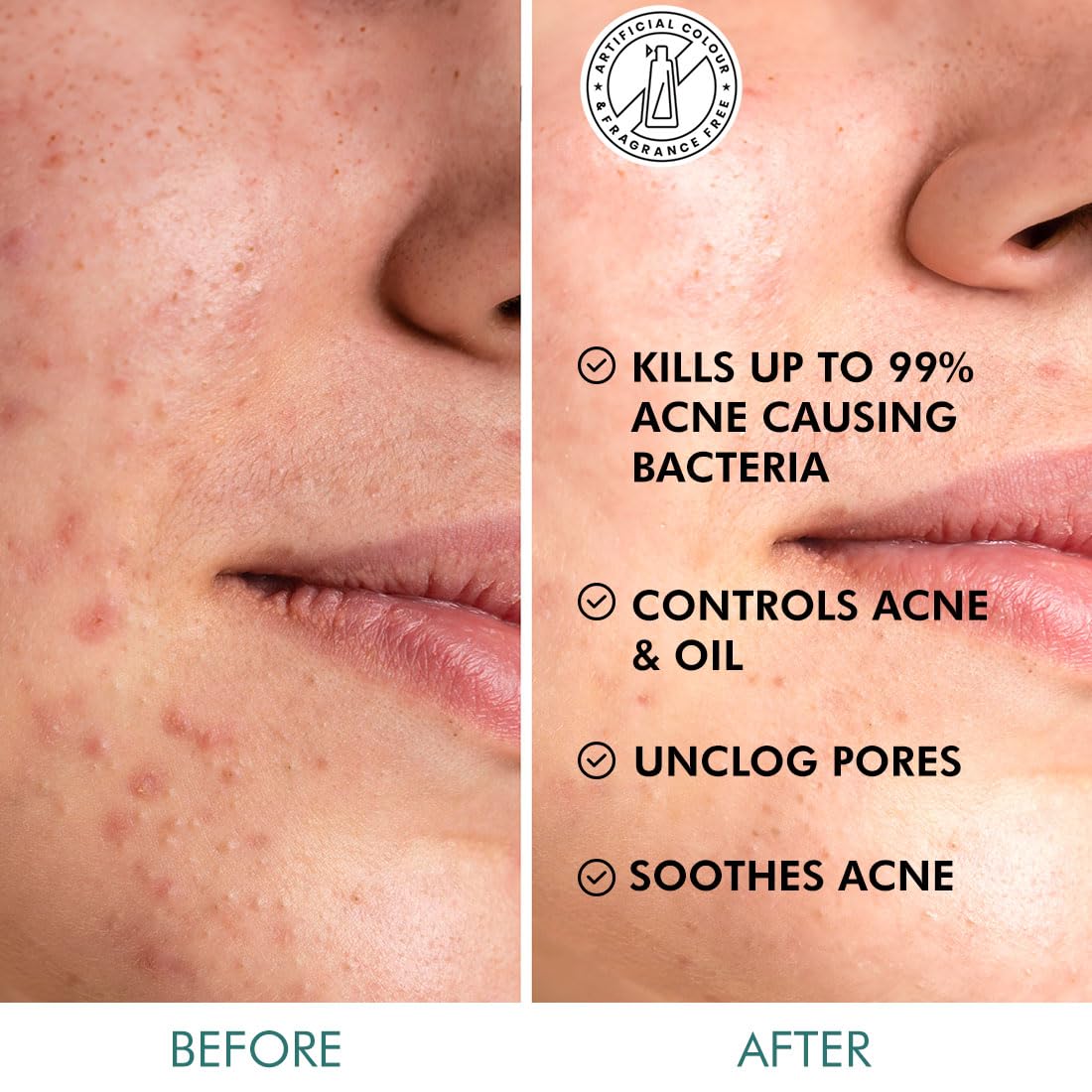 Before and after comparison of acne-prone skin with product benefits listed.