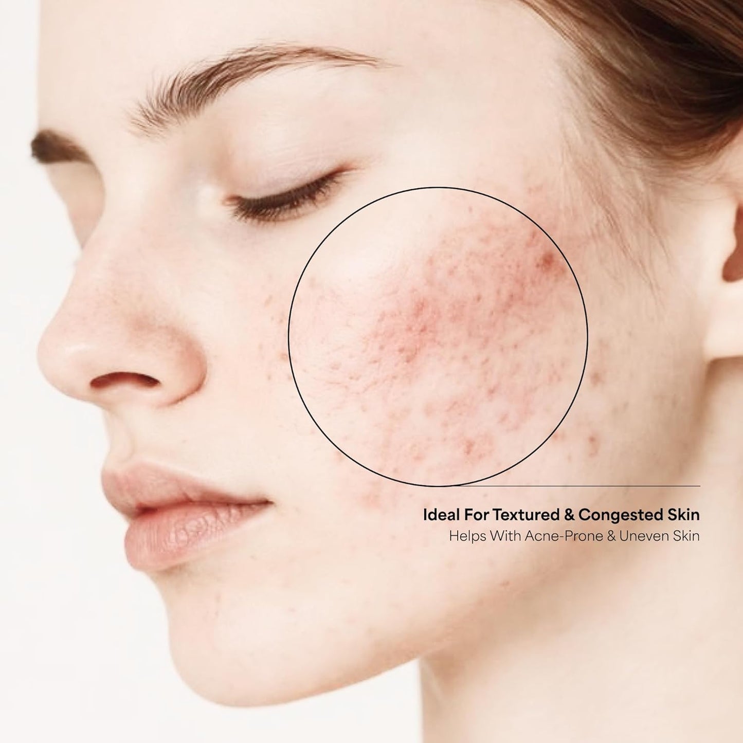 The True Therapy 30% AHA + 2% BHA + 5% PHA Skin Peeling Solution for Instant Glowing Skin – 30 ml