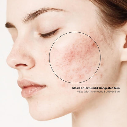 The True Therapy 30% AHA + 2% BHA + 5% PHA Skin Peeling Solution for Instant Glowing Skin – 30 ml