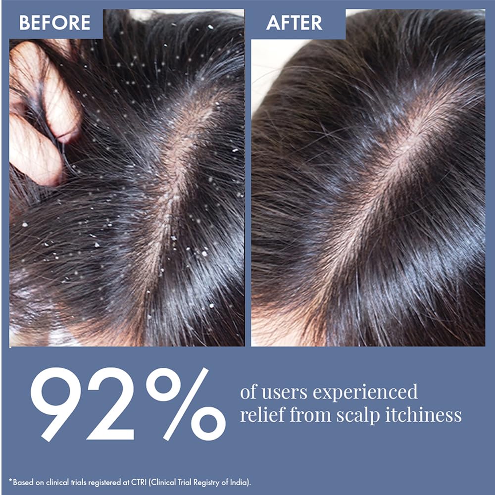 Before and after comparison of scalp with relief from itchiness, showing 92% user satisfaction.
