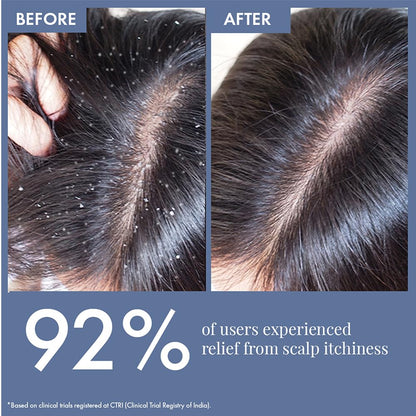 Before and after comparison of scalp with relief from itchiness, showing 92% user satisfaction.