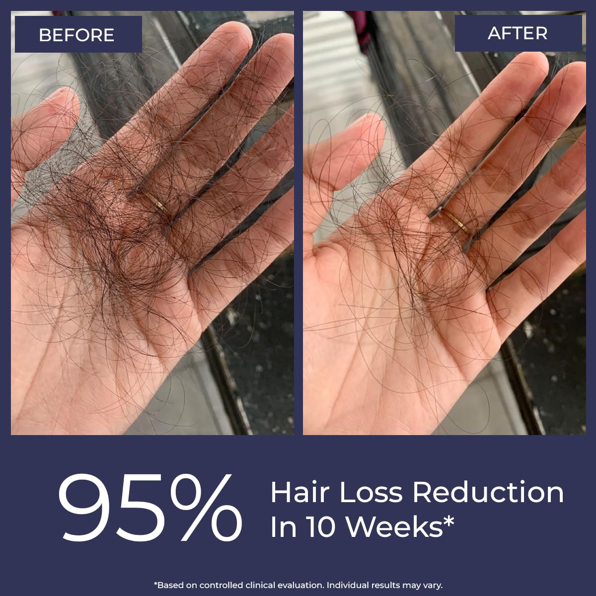 Hand with hair loss before and after treatment showing 95% reduction in hair loss.