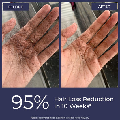 Hand with hair loss before and after treatment showing 95% reduction in hair loss.