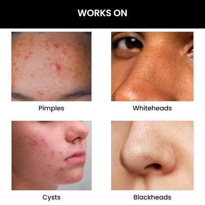 Before and after effects of a skincare product on various skin issues.