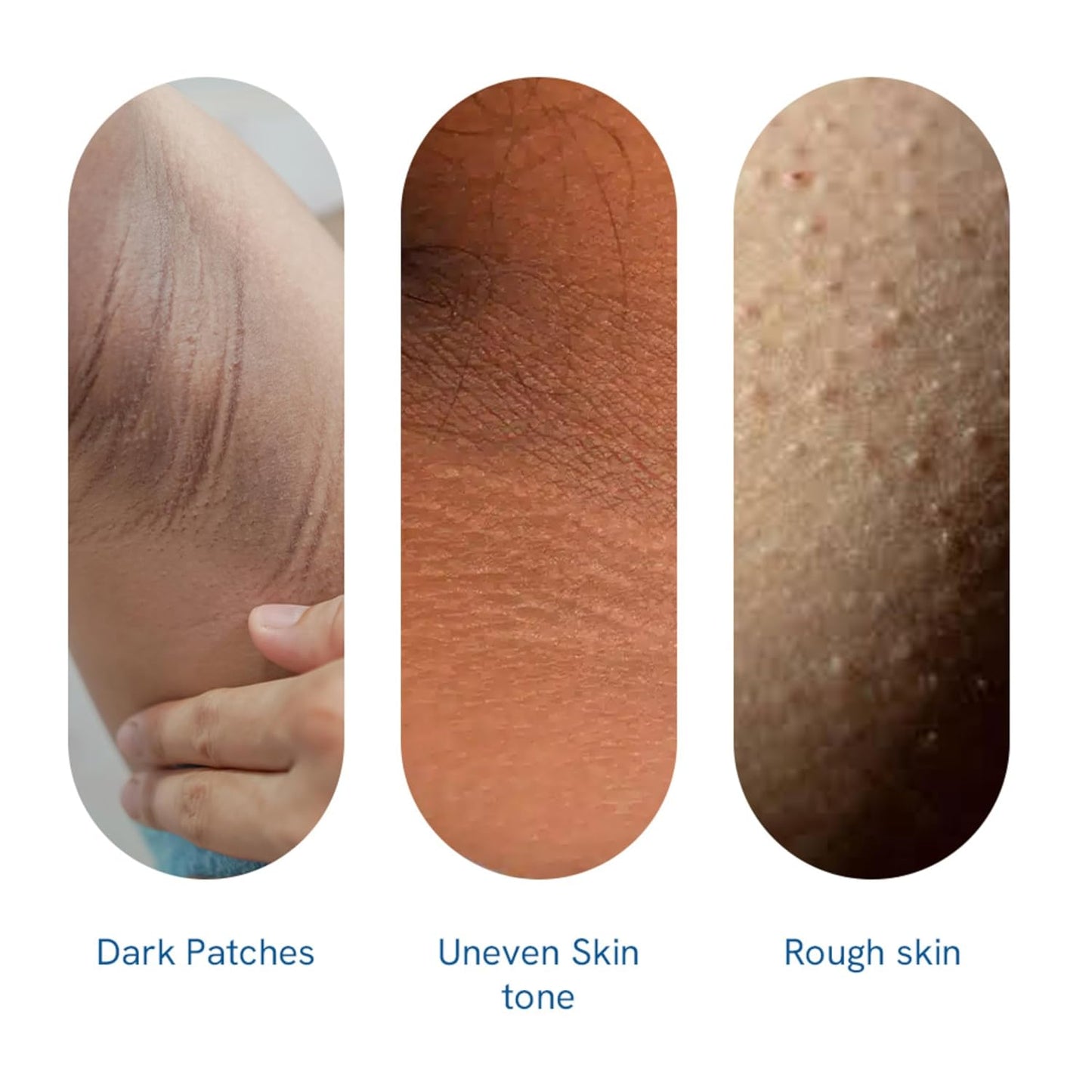 Be Bodywise Pigmentation Cream 100gm | 2.5% Lactic Acid, 2% Urea, Retinol & Kojic Acid | Reduces Tan, Pigmentation & Evens Skin Tone | Treats Dark Patches & Rough Skin on Elbows, Knees, Back of Neck & Thighs | For Daily Use