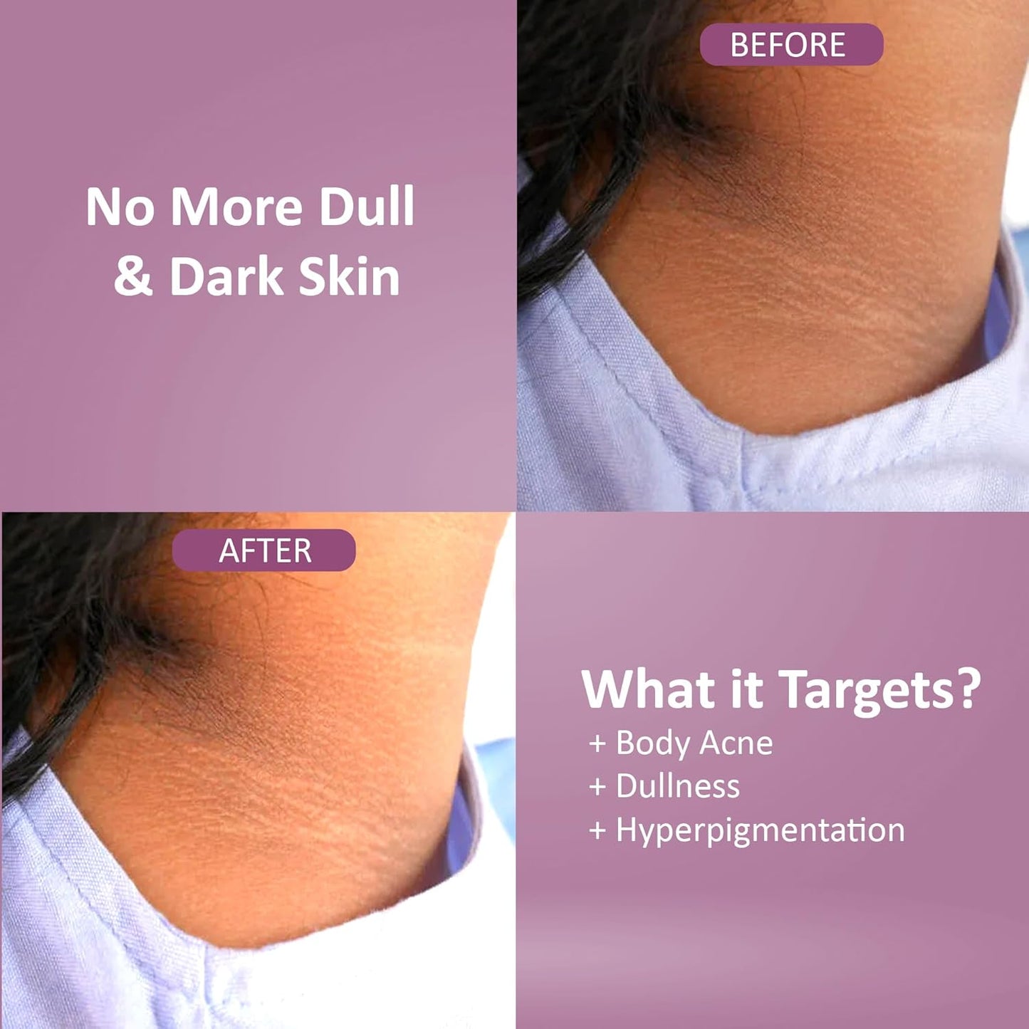 Neck & Back Cream | Exfoliating & Brightening Cream for neck, ankles, knuckles, Armpits, Thighs, Elbows | For Men & Women (30g)