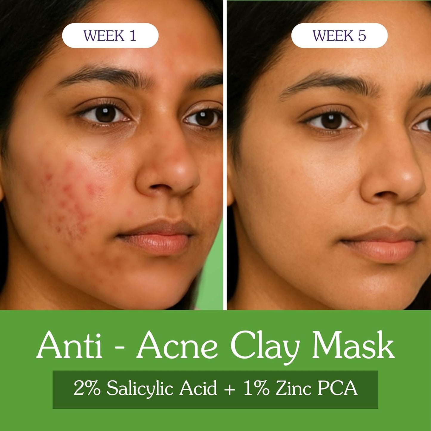 BAKE 2% Salicylic Acid Clay Mask Niacinamide for Acne Prone, Oily Skin, Open Pores & Blackheads | Anti Acne Clay Mask with Kaolin Clay | For Dark Spots, Oily Skin & Blemishes - 100g (Anti Acne)