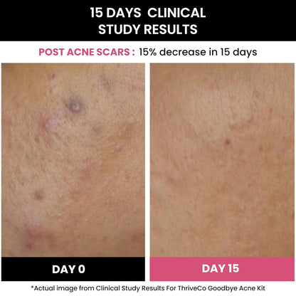 Before and after comparison of post-acne scars with text indicating a 15% decrease in 15 days.